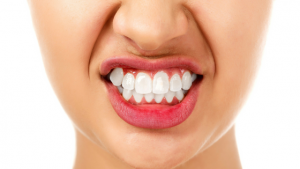 karalee-dental-ipswich-dentist-oral-splints-tmj-bruxism-grinding-teeth