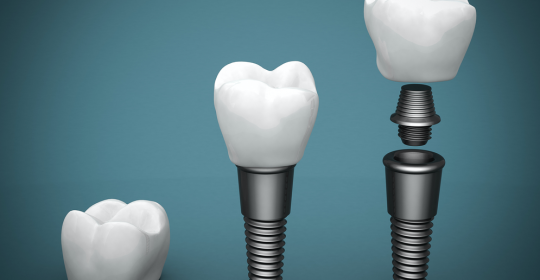 Missing Teeth? Everything You Need to Know about Dental Implants