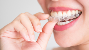 The Dos and Don’ts of Cleaning Invisalign Aligners