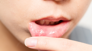 How to Soothe Mouth Ulcers
